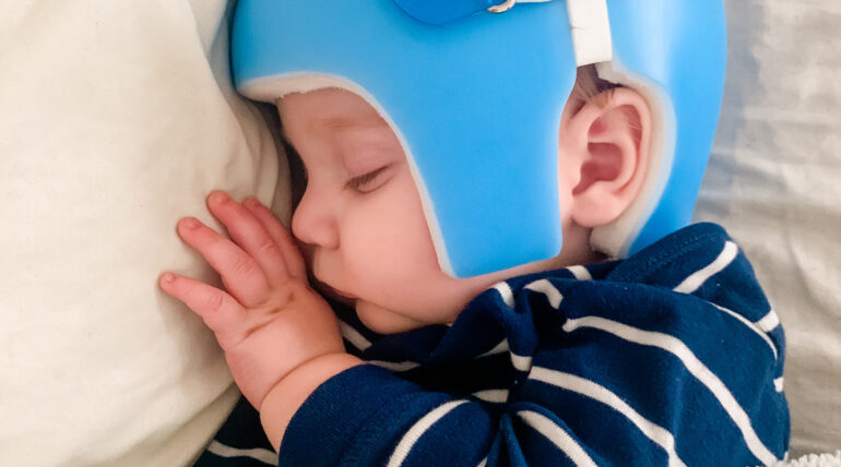 Sleepless Nights Over – Getting Baby to Snooze Sweetly in a Cranial Helmet